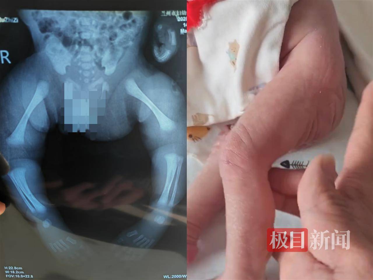 二胎出生查出先天性病症或落下残疾<strong></p>
<p>重生之金融巨擘</strong>，残疾父母称医院产检漏检、未尽告知义务，医院及医调委回应
